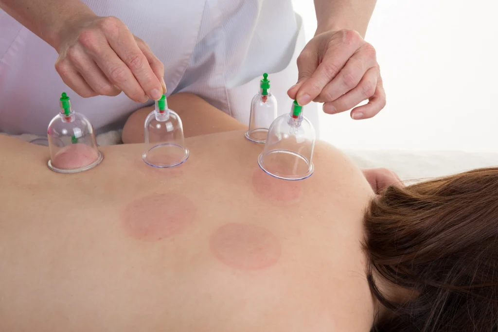 Close-up of cupping therapy on client's back at Well Adjusted Alpharetta.